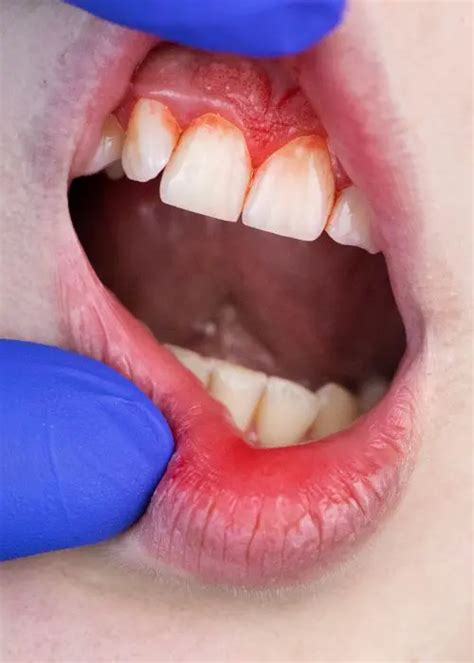 gum disease treatment bradenton fl|Gum Disease .